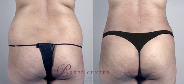 Liposuction Case 698 Before & After View #3 | Paramus, NJ | Parker Center for Plastic Surgery