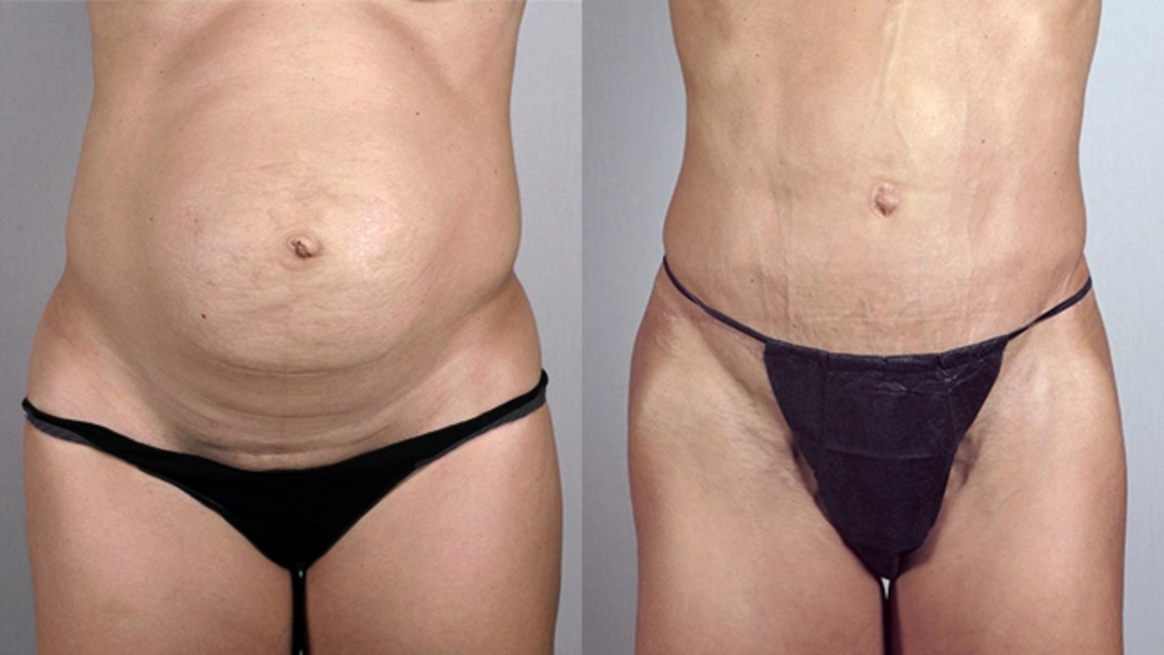 Tummy Tuck Case 699 Before & After View #1 | Paramus, New Jersey | Parker Center for Plastic Surgery