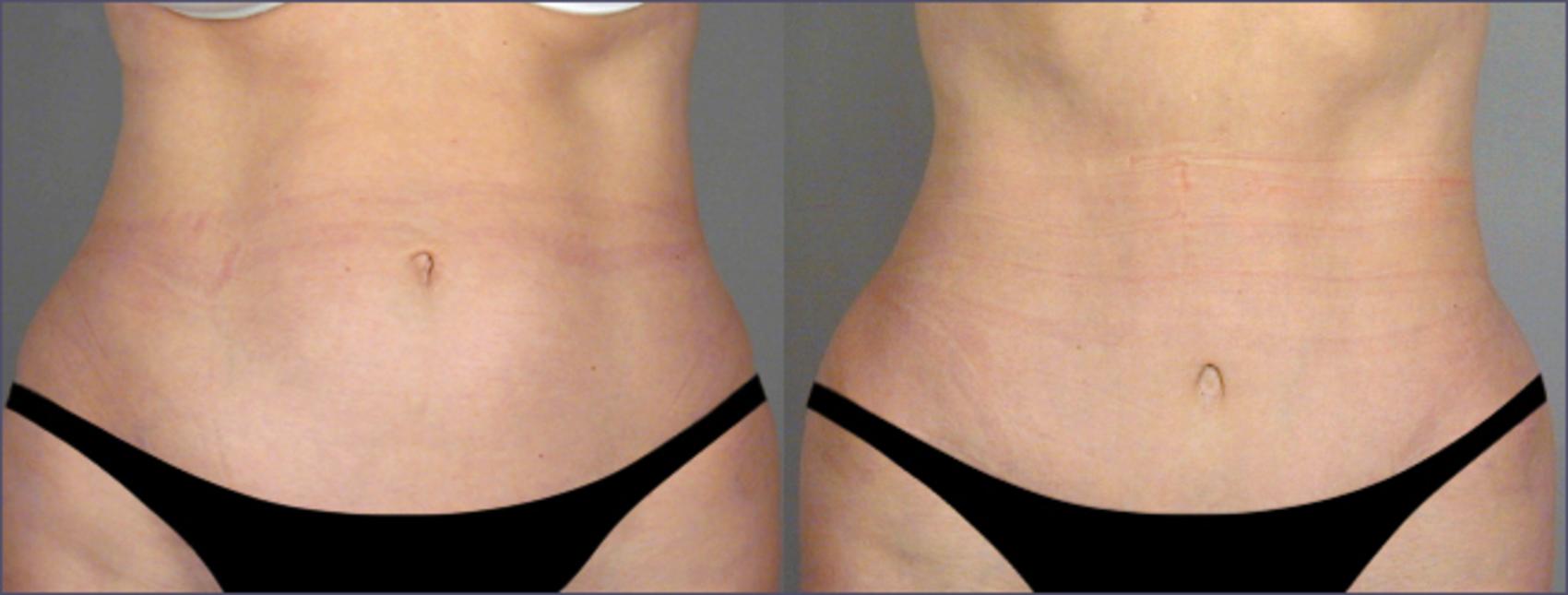 Tummy Tuck Case 700 Before & After View #1 | Paramus, NJ | Parker Center for Plastic Surgery