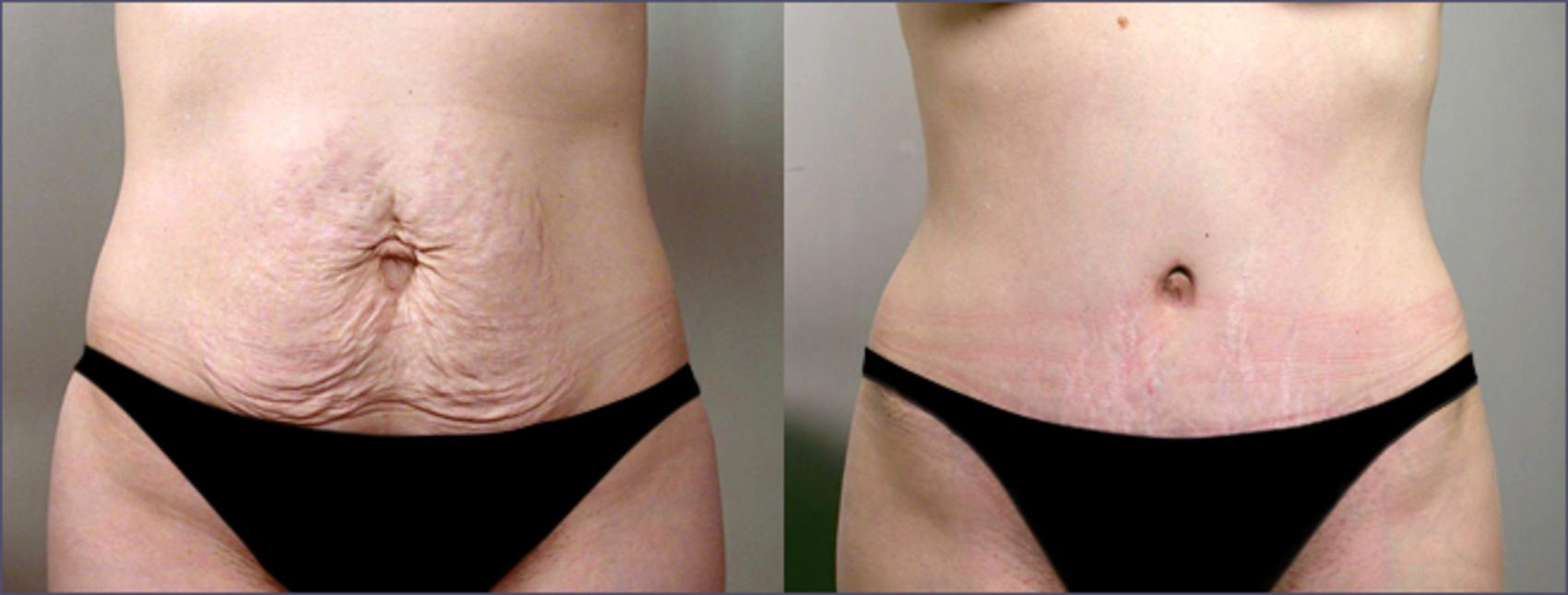 Tummy Tuck Case 701 Before & After View #1 | Paramus, NJ | Parker Center for Plastic Surgery