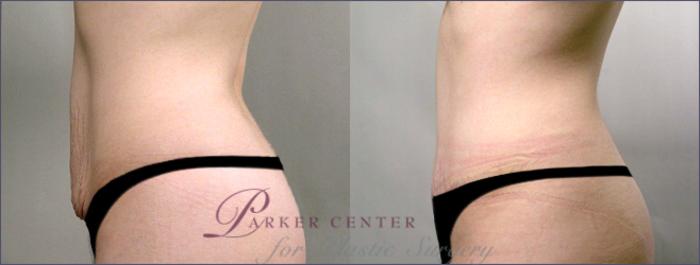 Tummy Tuck Case 701 Before & After View #2 | Paramus, NJ | Parker Center for Plastic Surgery