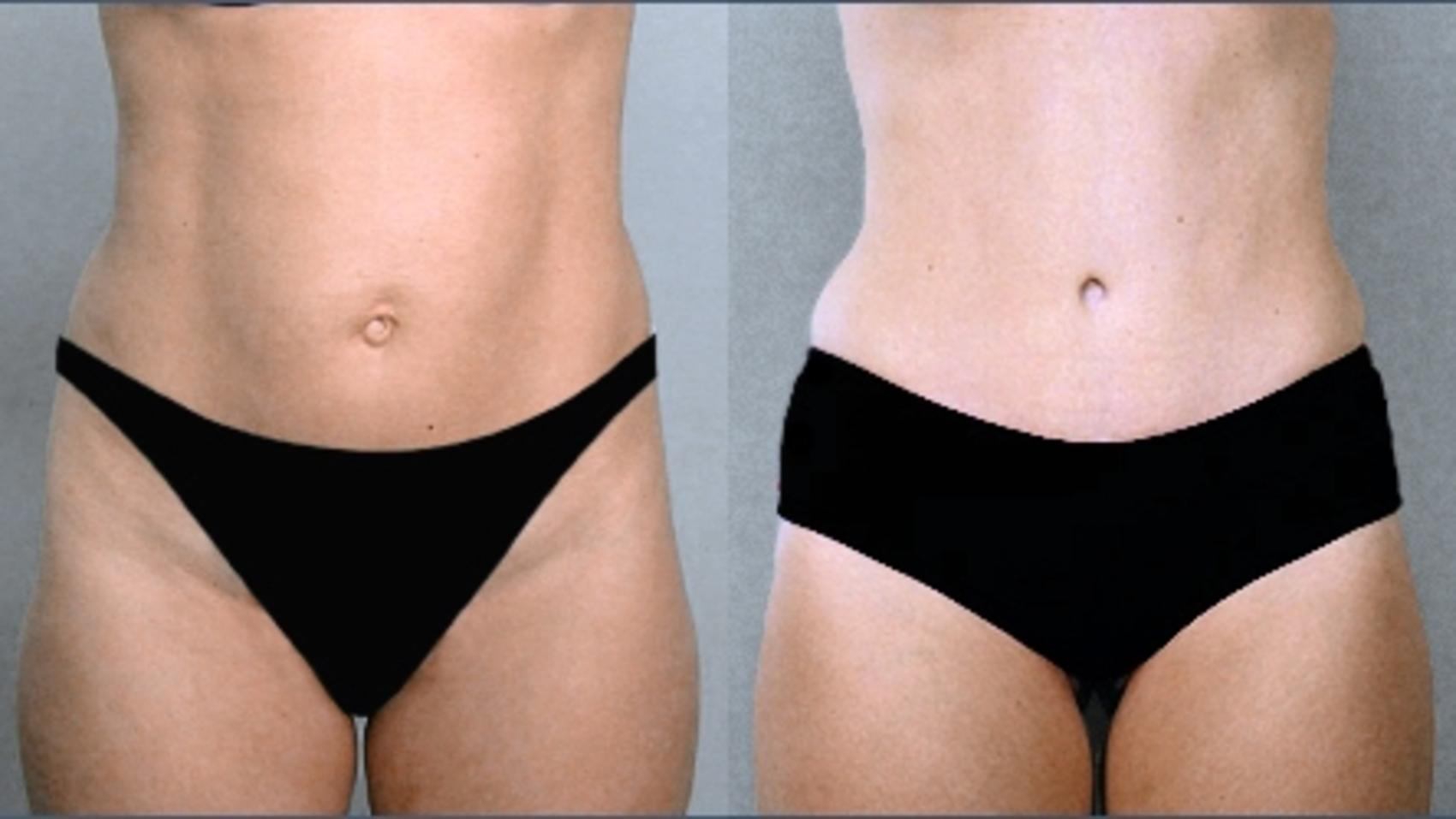 Tummy Tuck Case 702 Before & After View #1 | Paramus, NJ | Parker Center for Plastic Surgery