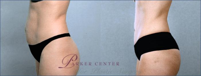Tummy Tuck Case 702 Before & After View #2 | Paramus, NJ | Parker Center for Plastic Surgery