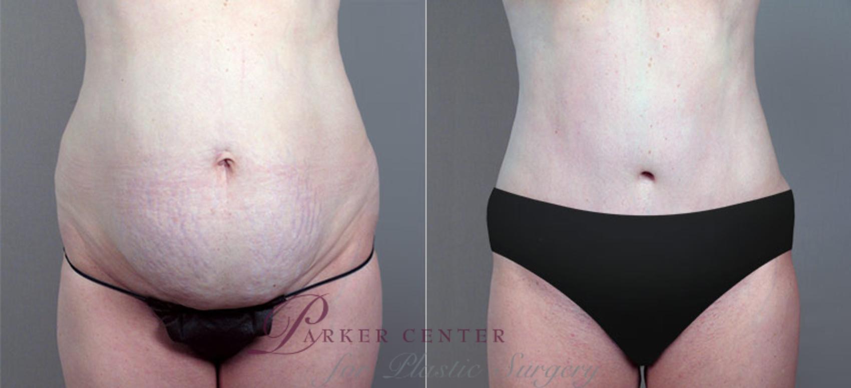 Liposuction Case 703 Before & After View #1 | Paramus, NJ | Parker Center for Plastic Surgery
