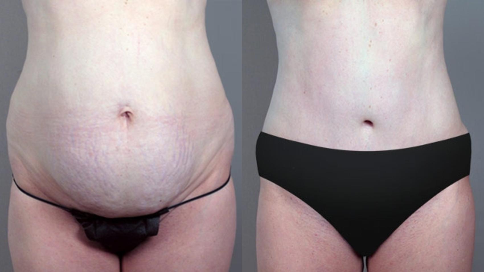 Tummy Tuck Case 703 Before & After View #1 | Paramus, NJ | Parker Center for Plastic Surgery