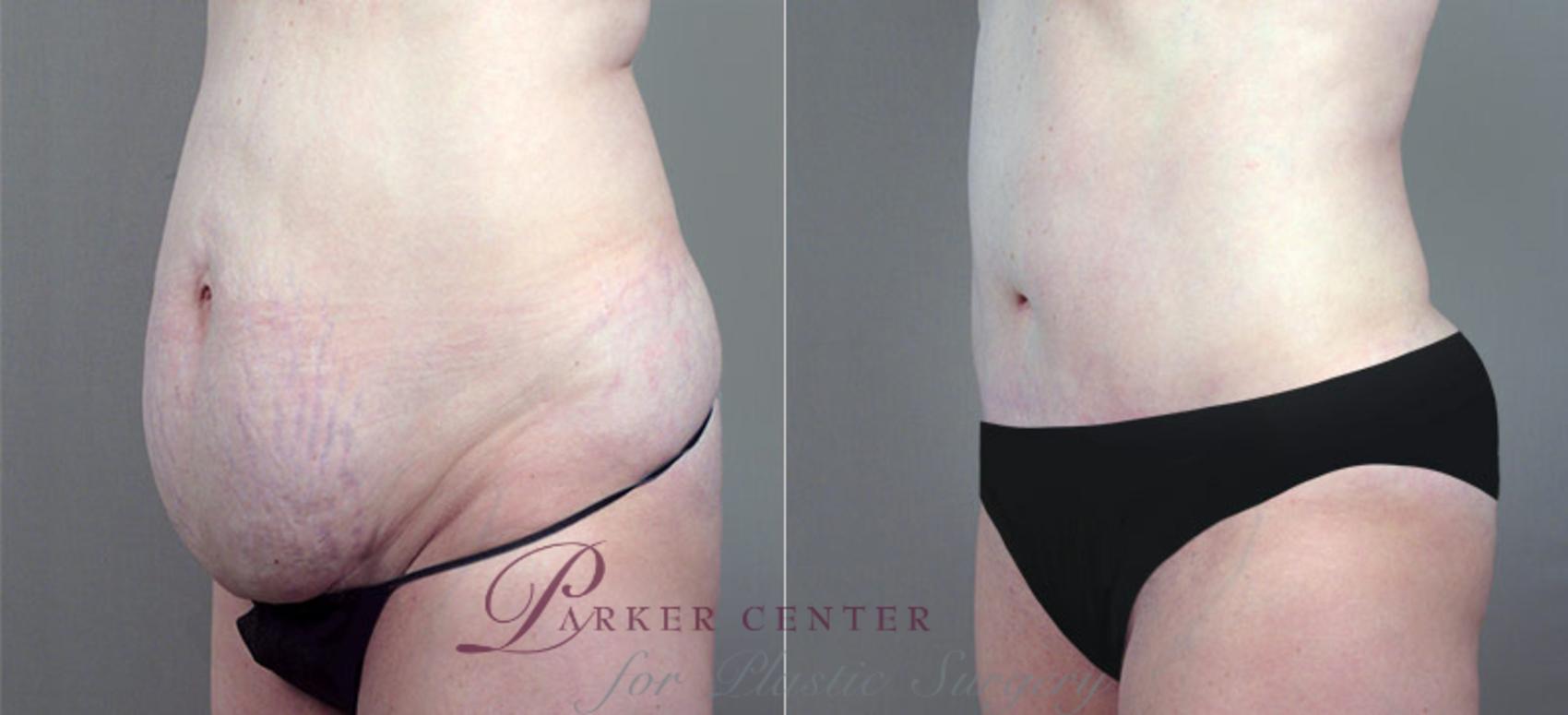 Liposuction Case 703 Before & After View #2 | Paramus, NJ | Parker Center for Plastic Surgery