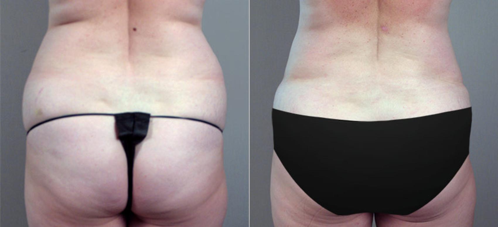 Tummy Tuck Case 703 Before & After View #3 | Paramus, New Jersey | Parker Center for Plastic Surgery