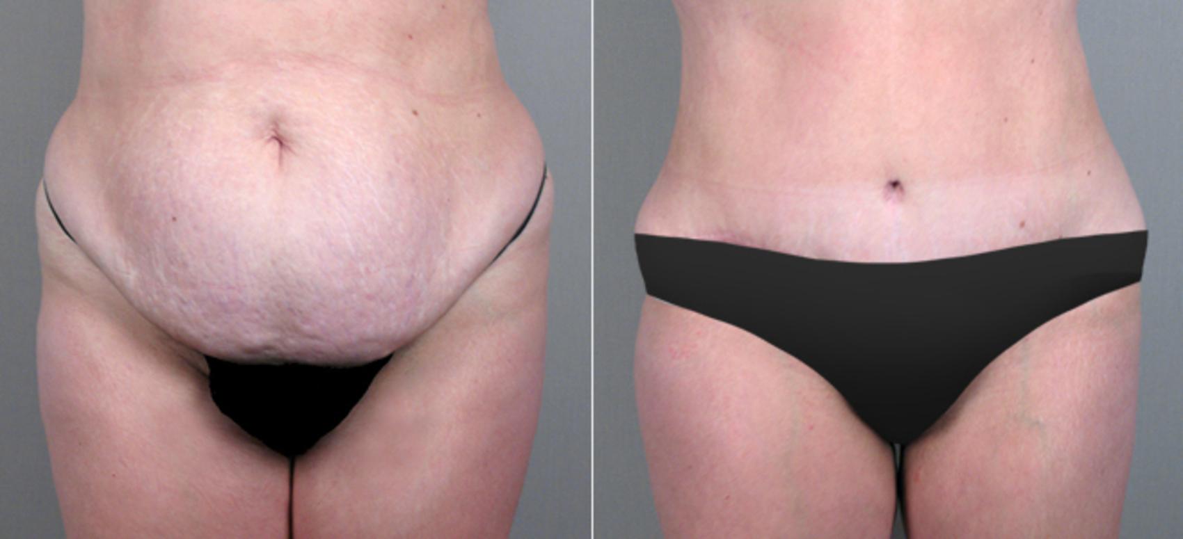 Tummy Tuck Case 706 Before & After View #1 | Paramus, NJ | Parker Center for Plastic Surgery