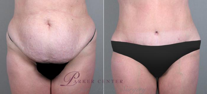 Liposuction Case 706 Before & After View #1 | Paramus, NJ | Parker Center for Plastic Surgery