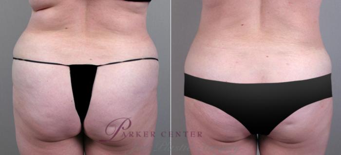 Liposuction Case 706 Before & After View #3 | Paramus, NJ | Parker Center for Plastic Surgery