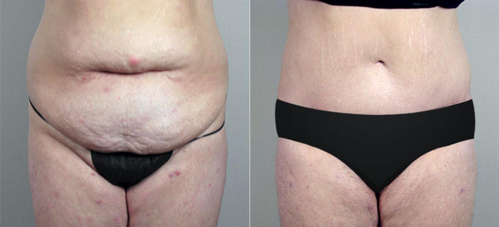 Tummy Tuck Case 707 Before & After View #1 | Paramus, NJ | Parker Center for Plastic Surgery