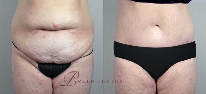 Liposuction Case 707 Before & After View #1 | Paramus, NJ | Parker Center for Plastic Surgery