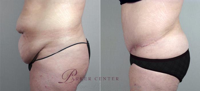 Liposuction Case 707 Before & After View #2 | Paramus, NJ | Parker Center for Plastic Surgery