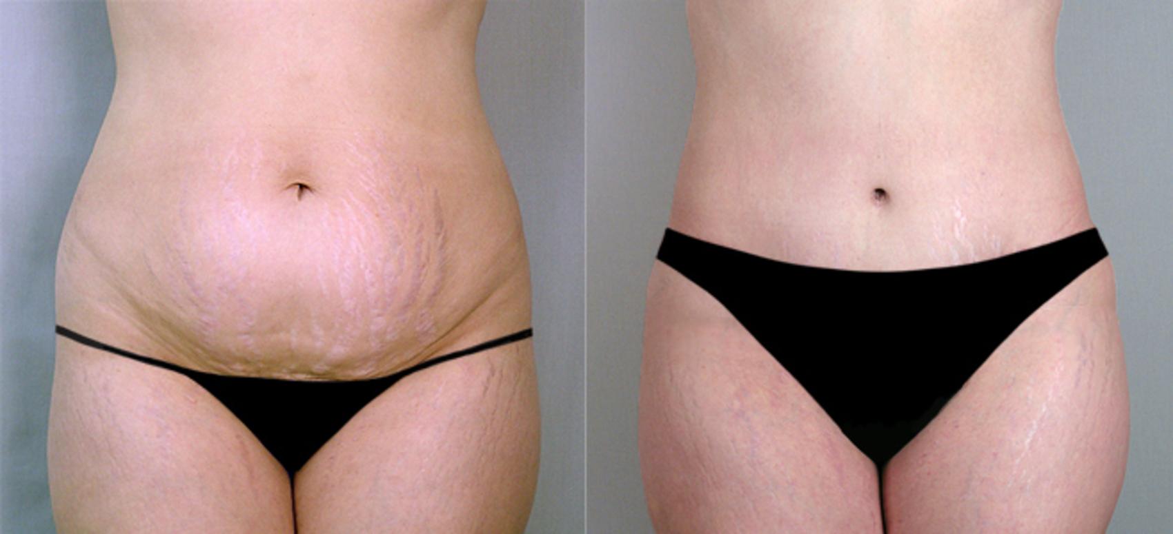 Tummy Tuck Case 708 Before & After View #1 | Paramus, NJ | Parker Center for Plastic Surgery