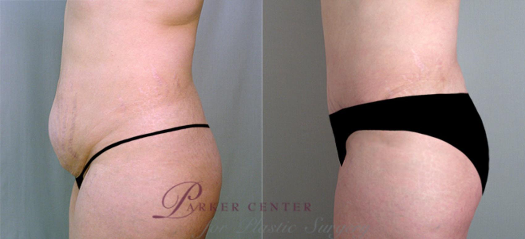 Tummy Tuck Case 708 Before & After View #2 | Paramus, New Jersey | Parker Center for Plastic Surgery