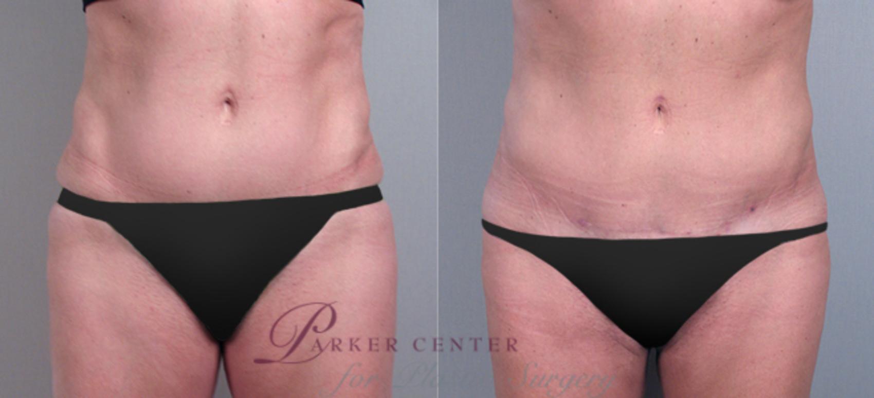 Tummy Tuck Case 709 Before & After View #1 | Paramus, NJ | Parker Center for Plastic Surgery