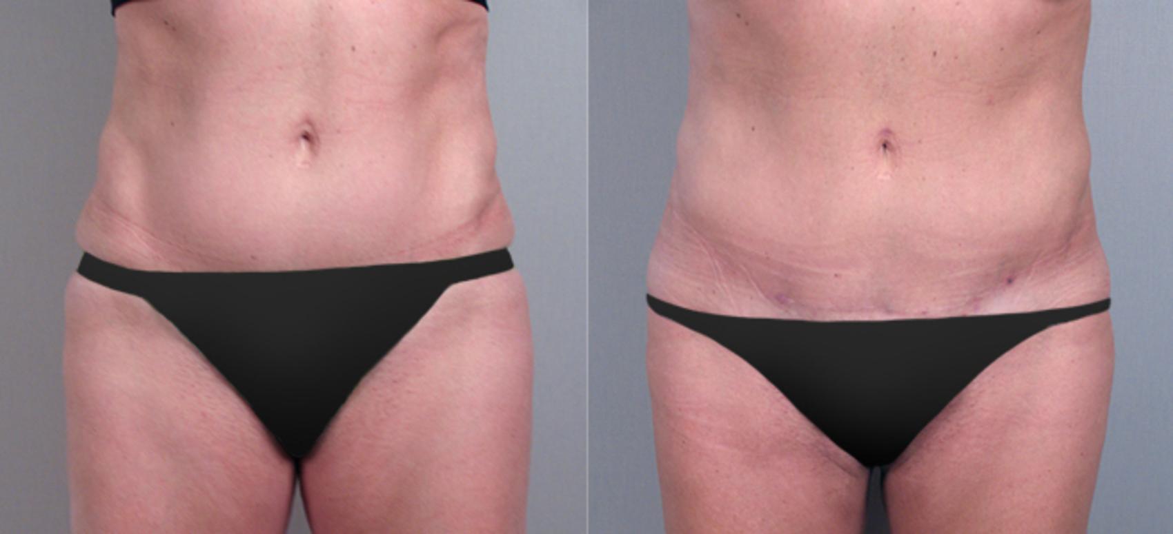 Tummy Tuck Case 709 Before & After View #1 | Paramus, New Jersey | Parker Center for Plastic Surgery