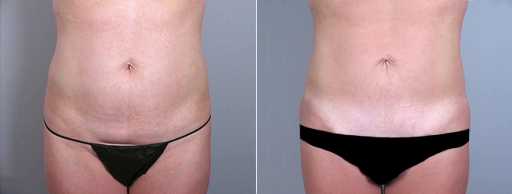 Tummy Tuck Case 710 Before & After View #1 | Paramus, New Jersey | Parker Center for Plastic Surgery