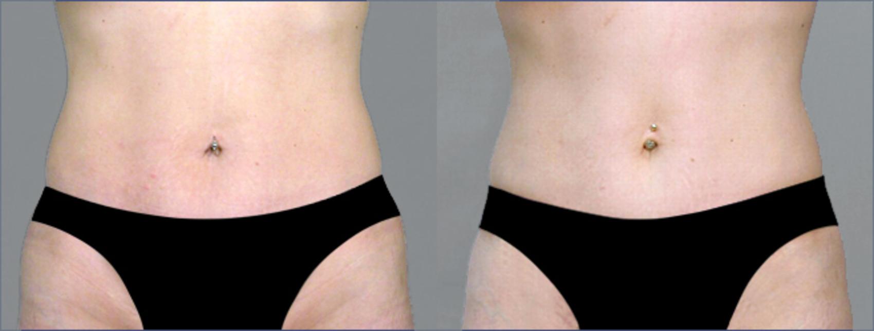 Tummy Tuck Case 711 Before & After View #1 | Paramus, NJ | Parker Center for Plastic Surgery