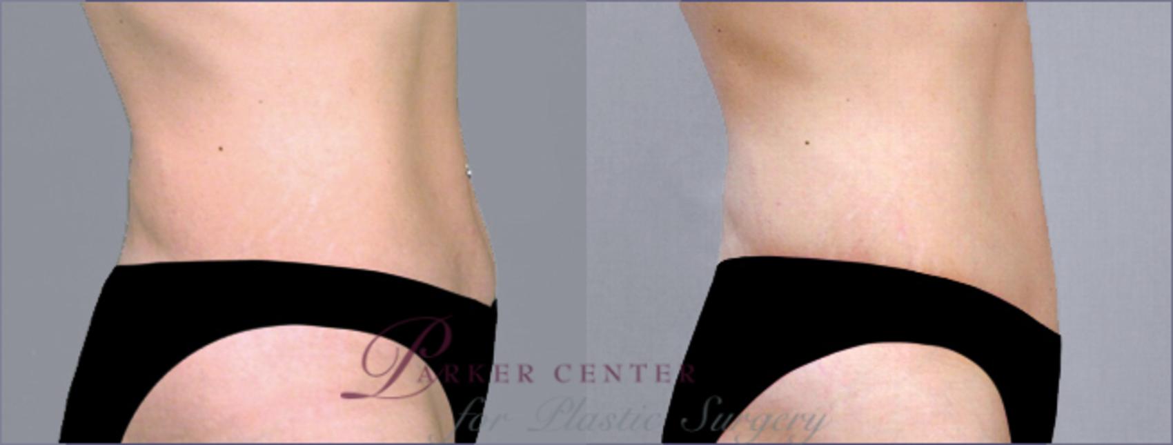 Tummy Tuck Case 711 Before & After View #2 | Paramus, New Jersey | Parker Center for Plastic Surgery