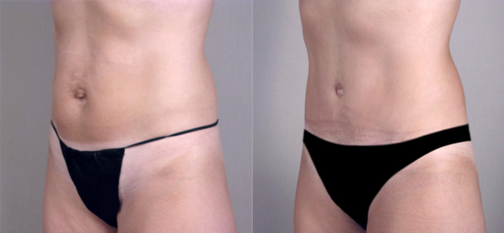 Tummy Tuck Case 712 Before & After View #1 | Paramus, New Jersey | Parker Center for Plastic Surgery