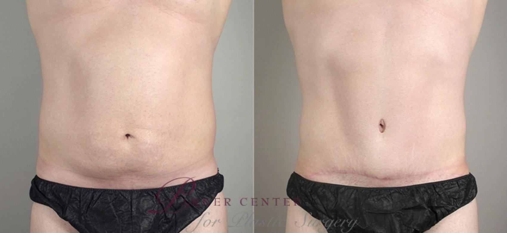 Abdominoplasty Case 713 Before & After View #1 | Paramus, NJ | Parker Center for Plastic Surgery
