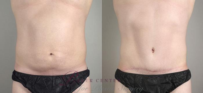 Liposuction Case 713 Before & After View #1 | Paramus, NJ | Parker Center for Plastic Surgery