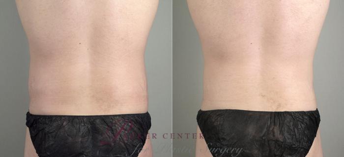 Liposuction Case 713 Before & After View #3 | Paramus, NJ | Parker Center for Plastic Surgery