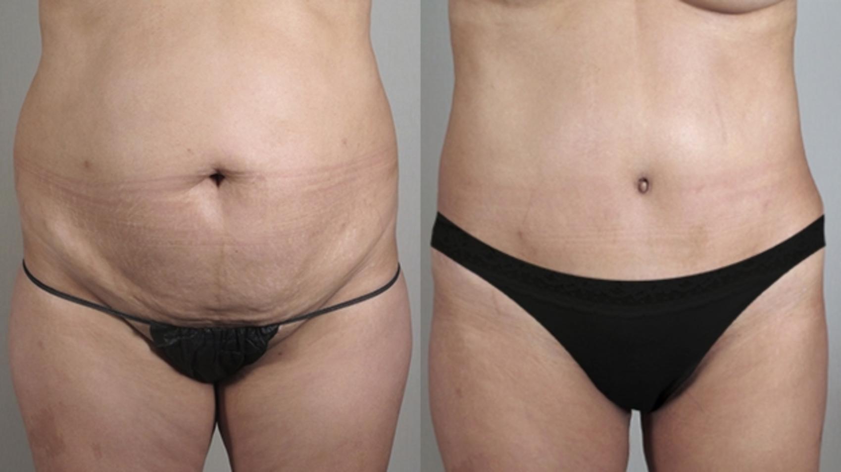 Liposuction Case 715 Before & After View #1 | Paramus, NJ | Parker Center for Plastic Surgery