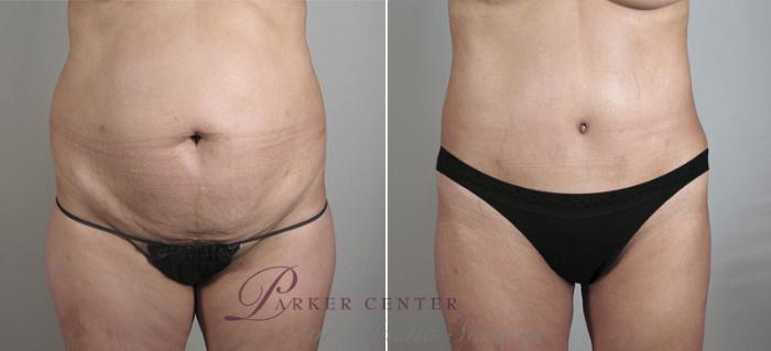 Liposuction Case 715 Before & After View #1 | Paramus, NJ | Parker Center for Plastic Surgery