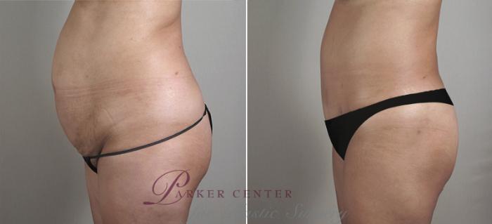 Liposuction Case 715 Before & After View #2 | Paramus, NJ | Parker Center for Plastic Surgery