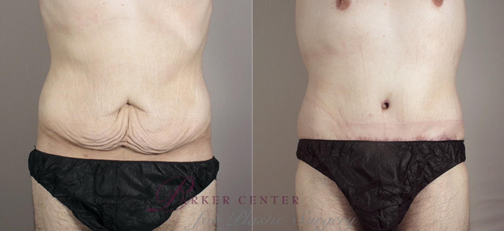 Tummy Tuck Case 716 Before & After View #1 | Paramus, NJ | Parker Center for Plastic Surgery