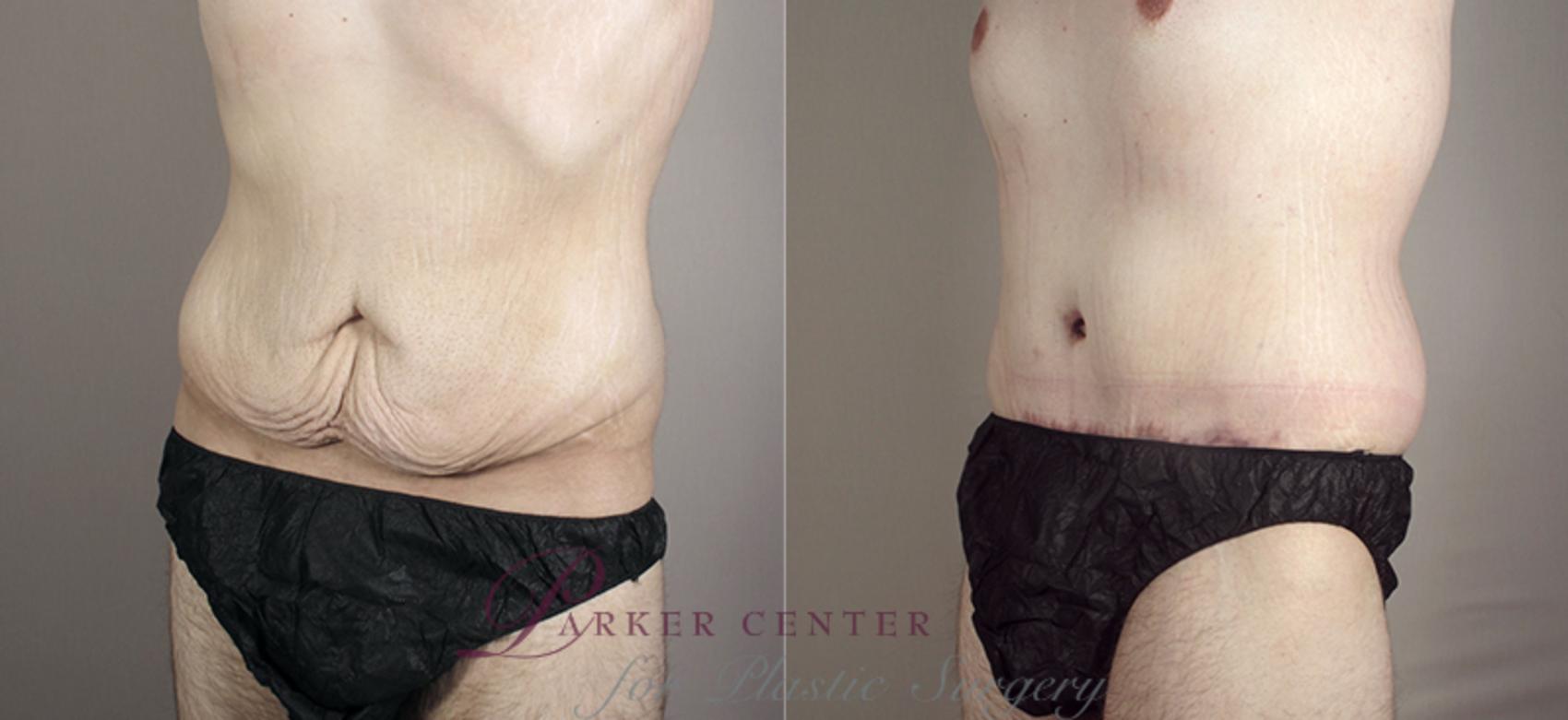 Abdominoplasty Case 716 Before & After View #2 | Paramus, NJ | Parker Center for Plastic Surgery