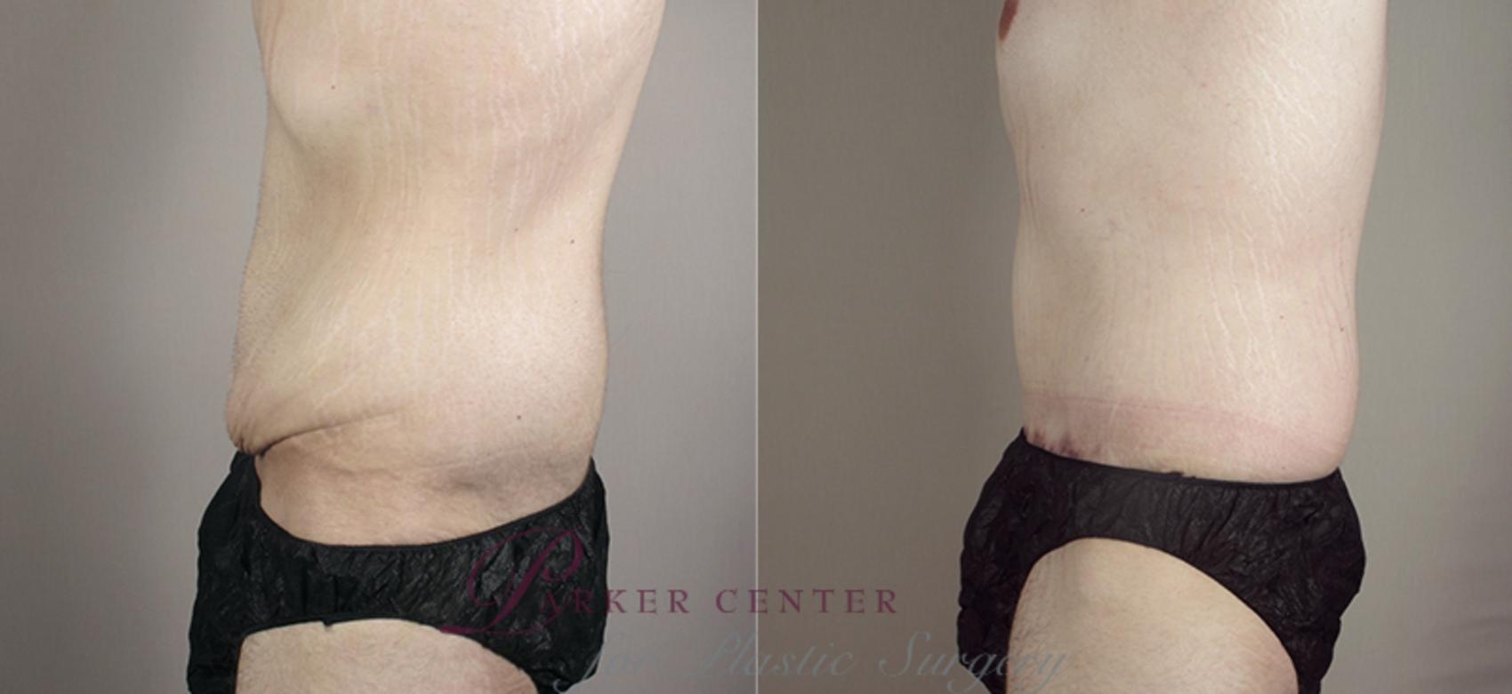 Abdominoplasty Case 716 Before & After View #3 | Paramus, NJ | Parker Center for Plastic Surgery