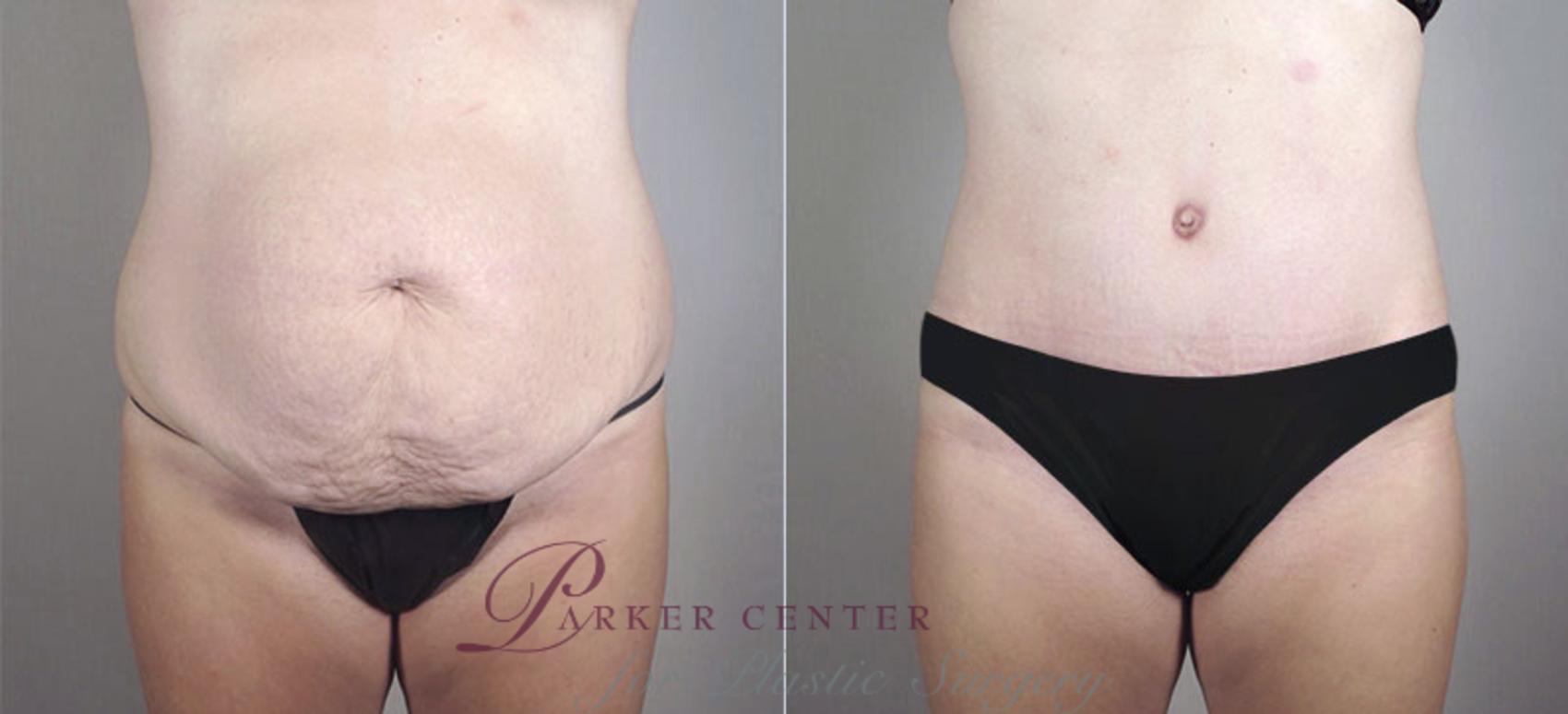 Liposuction Case 718 Before & After View #1 | Paramus, NJ | Parker Center for Plastic Surgery