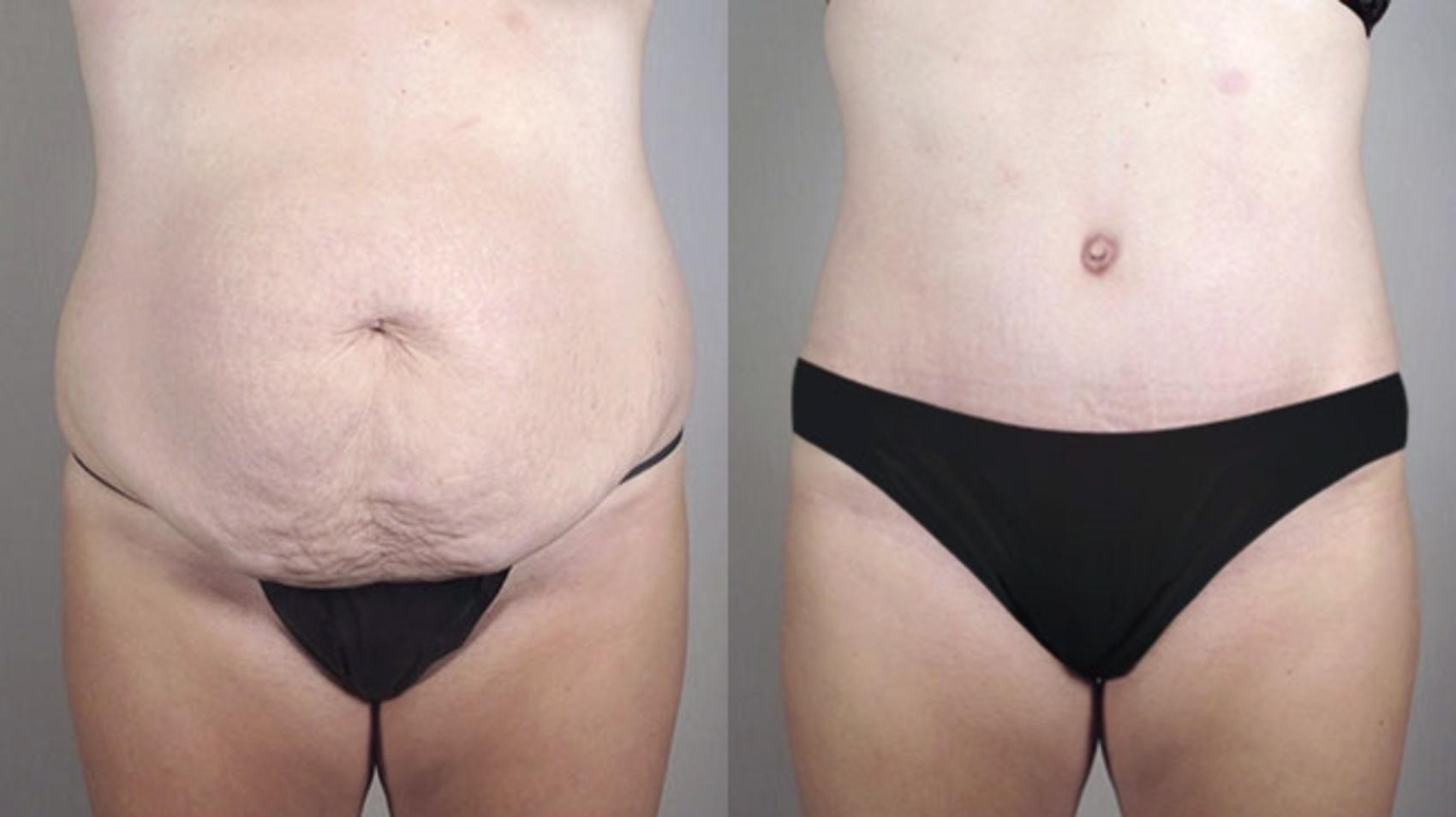 Tummy Tuck Case 718 Before & After View #1 | Paramus, NJ | Parker Center for Plastic Surgery