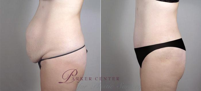 Liposuction Case 718 Before & After View #2 | Paramus, NJ | Parker Center for Plastic Surgery