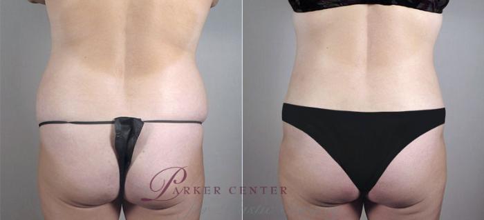 Liposuction Case 718 Before & After View #3 | Paramus, NJ | Parker Center for Plastic Surgery