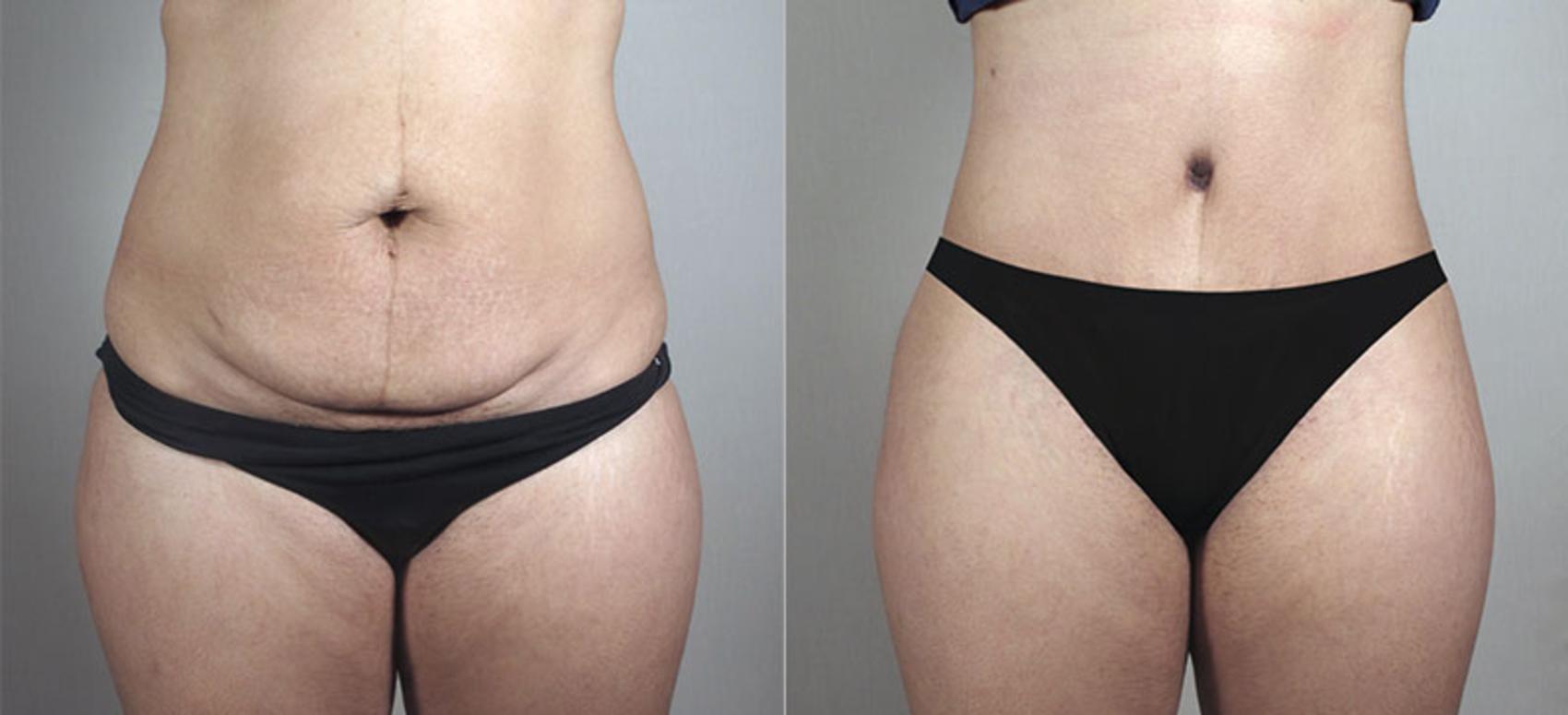 Liposuction Case 719 Before & After View #1 | Paramus, NJ | Parker Center for Plastic Surgery