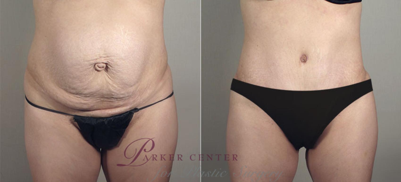 Liposuction Case 721 Before & After View #1 | Paramus, NJ | Parker Center for Plastic Surgery