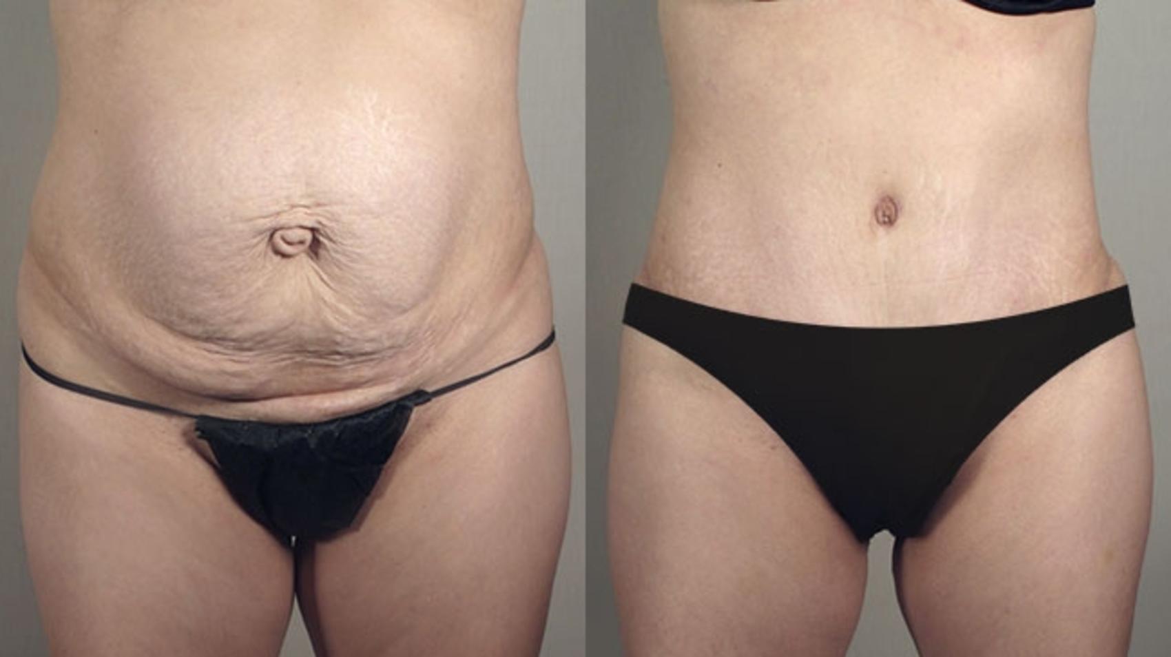 Tummy Tuck Case 721 Before & After View #1 | Paramus, New Jersey | Parker Center for Plastic Surgery