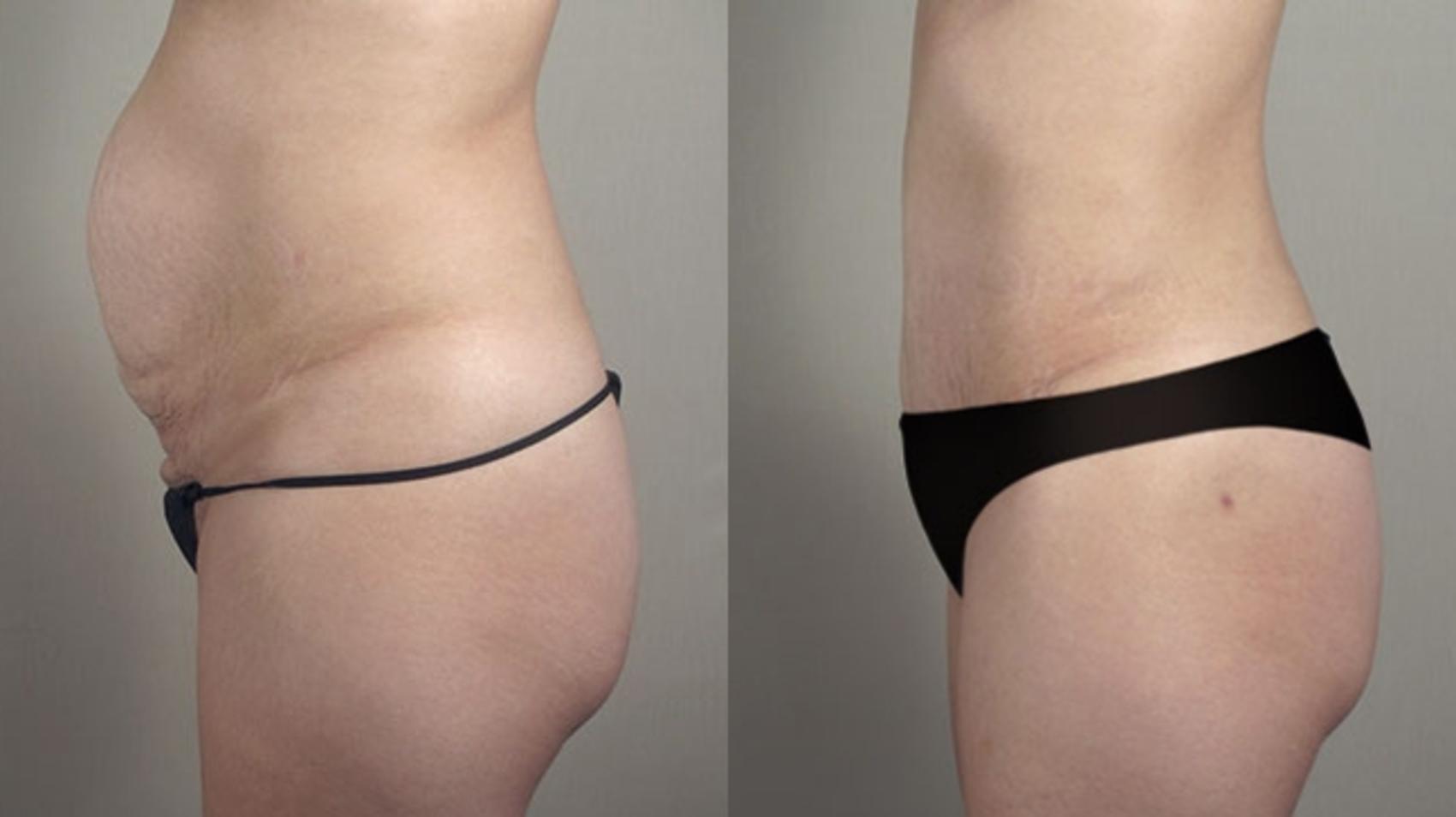 Tummy Tuck Case 721 Before & After View #2 | Paramus, New Jersey | Parker Center for Plastic Surgery