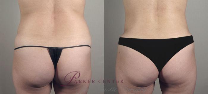 Liposuction Case 721 Before & After View #3 | Paramus, NJ | Parker Center for Plastic Surgery