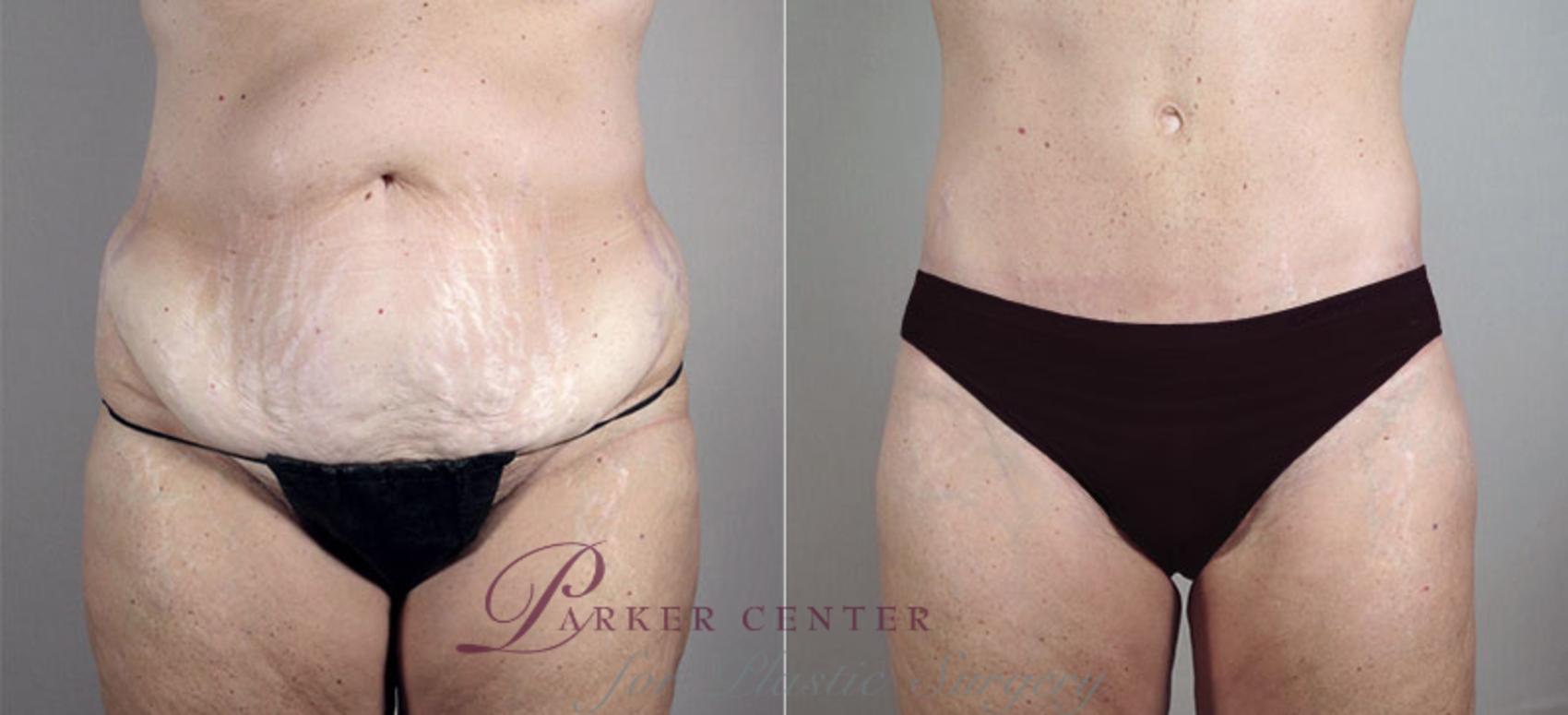 Liposuction Case 722 Before & After View #1 | Paramus, NJ | Parker Center for Plastic Surgery