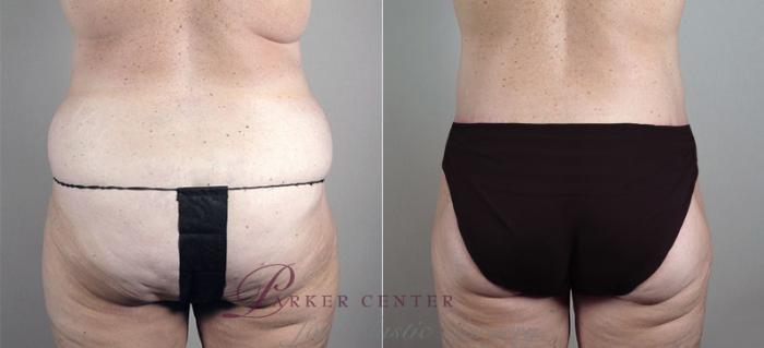 Liposuction Case 722 Before & After View #3 | Paramus, NJ | Parker Center for Plastic Surgery