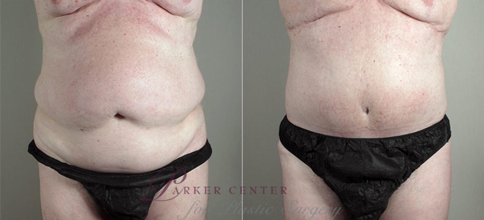 Tummy Tuck Case 723 Before & After View #1 | Paramus, NJ | Parker Center for Plastic Surgery