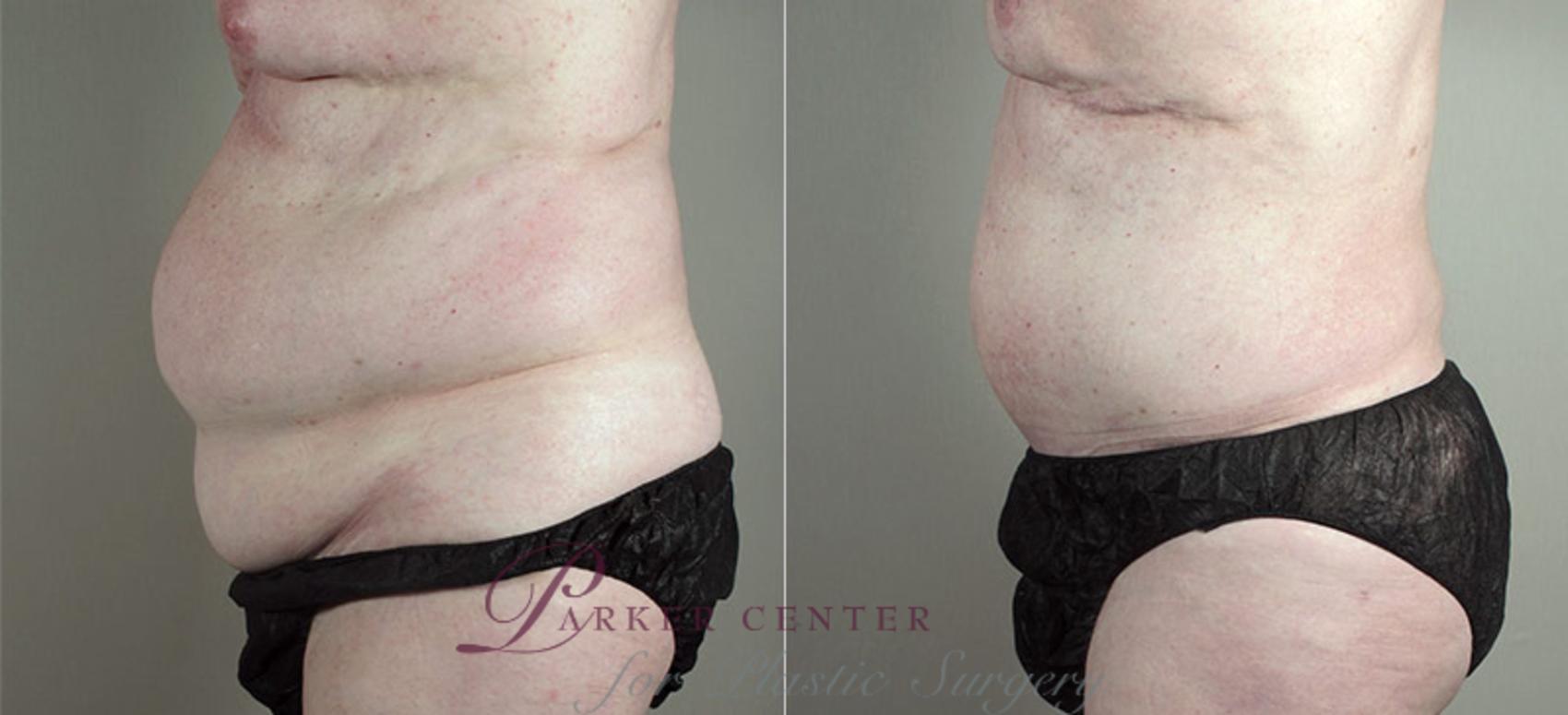 Abdominoplasty Case 723 Before & After View #2 | Paramus, NJ | Parker Center for Plastic Surgery