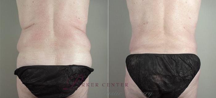 Tummy Tuck Case 723 Before & After View #3 | Paramus, NJ | Parker Center for Plastic Surgery