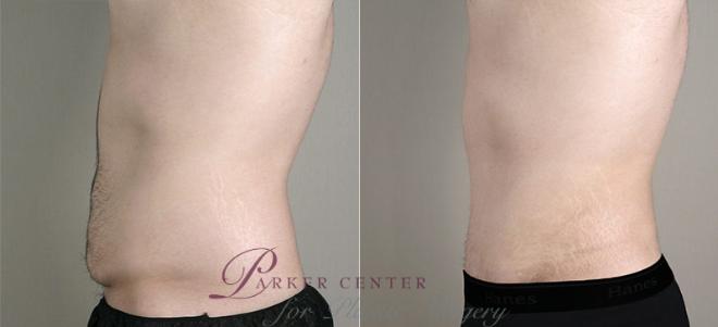 Abdominoplasty Case 724 Before & After View #2 | Paramus, NJ | Parker Center for Plastic Surgery