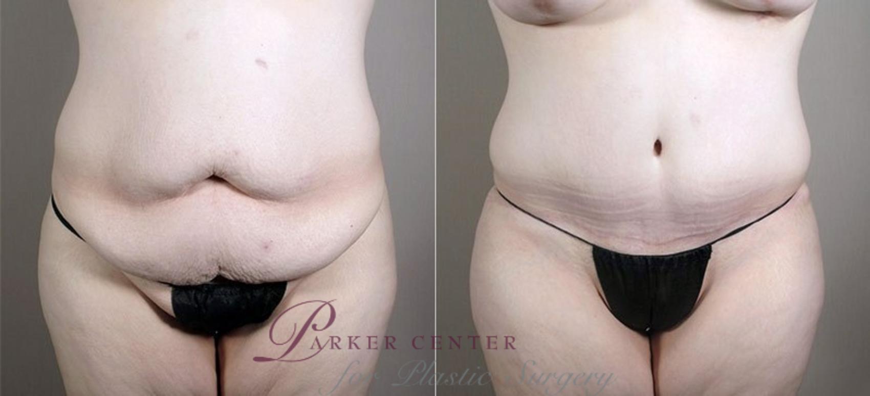 Liposuction Case 726 Before & After View #1 | Paramus, NJ | Parker Center for Plastic Surgery